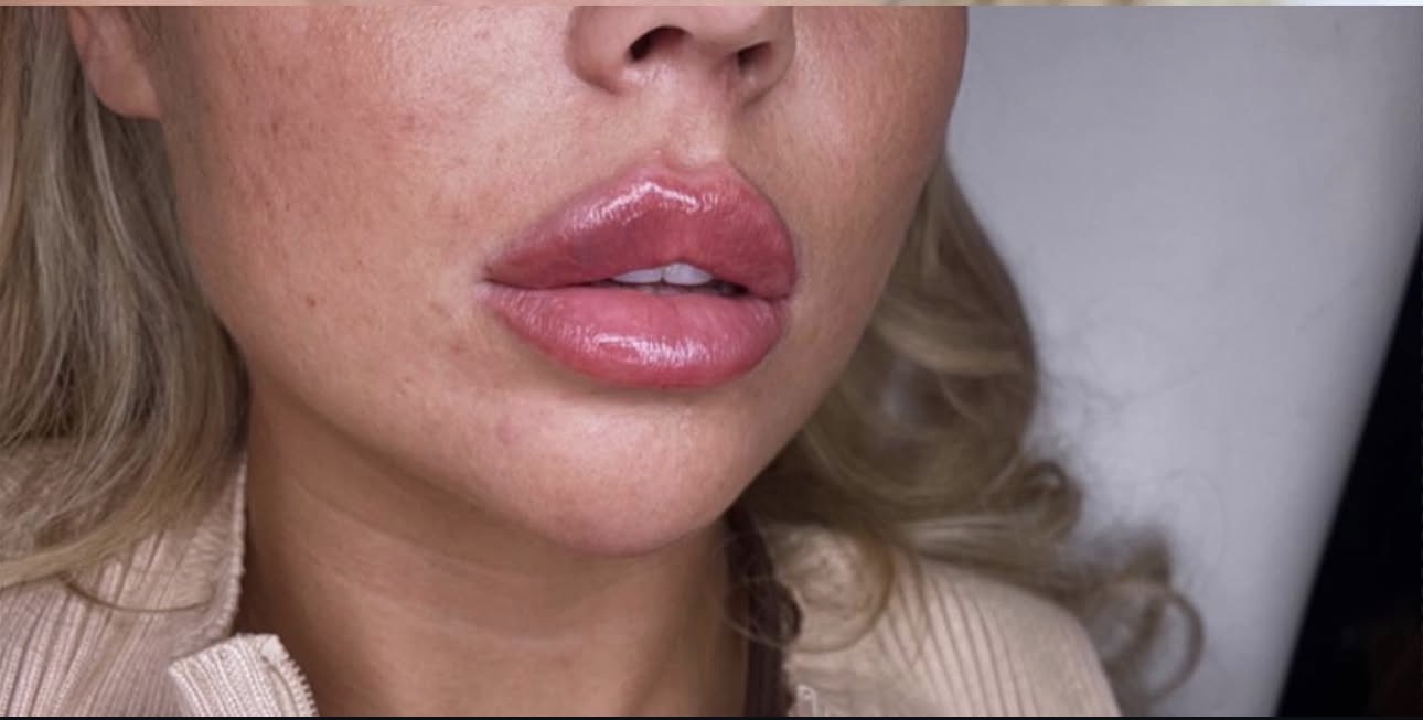 Lips after dermal filler enhancement